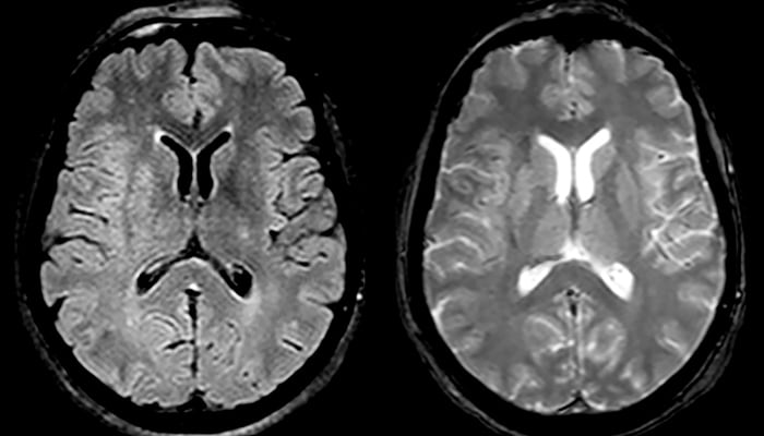 Mri In Ms Stroke Brain Tumor Fieldstrength Mri Philips Healthcare 9582