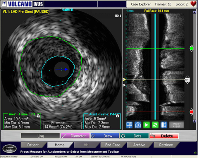 Intravascular Ultrasound (IVUS) | Philips Healthcare